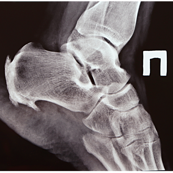 Bone Spurs