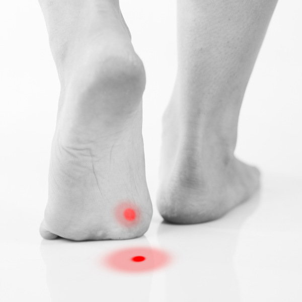 Plantar Warts