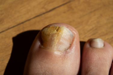 Toenail Fungus