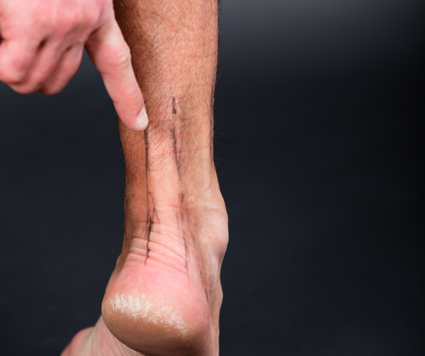 Peroneal tendonitis